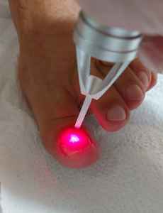 Podologi frekuensi tinggi podiatri dioe perangkat laser 980nm 47w untuk onychomycosis jamur infeksi jamur jamur kuku menghilangkan - Product Image 3