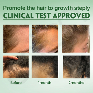 Traitement capillaire nourrissant à l'huile d'arbre à thé biologique de marque privée, favorise la croissance et apaise pour des cheveux sains - Product Image 5