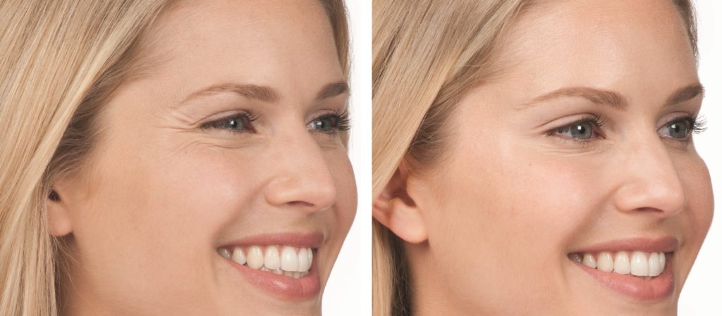 Multifunctional facial beauty Vmax Face Lifting RF HIFU Home Use Mini Skin Tightening Wrinkle Remover Machine