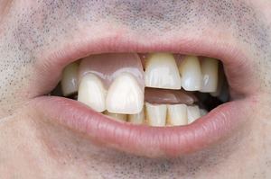 SHT multistrato dentale <span class=keywords><strong>zirconia</strong></span> ceramica multistrato <span class=keywords><strong>zirconia</strong></span> a1 <span class=keywords><strong>a2</strong></span> a3 colore dentale <span class=keywords><strong>zirconia</strong></span> <span class=keywords><strong>block</strong></span> - Product Image 3