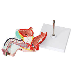 Modelo Patológico del Sistema Reproductor Masculino - Herramienta de Enseñanza Médica de Andrología y Comunicación Médico-Paciente - Product Image 2
