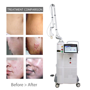 Equipo de Tratamiento Facial Fotona 4D 2026, el Más Rentable, Láser Fraccional de CO2 <span class=keywords><strong>para</strong></span> Dermatología, Máquina de Rejuvenecimiento Vaginal de 10600nm - Product Image 2