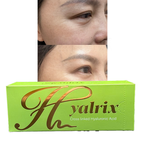 <span class=keywords><strong>Acide</strong></span> <span class=keywords><strong>hyaluronique</strong></span> de haute qualité, produit de comblement pour les ridules, 2 seringues de 1,1 ml chacune, produit injectable pour le traitement des rides superficielles - Product Image 3