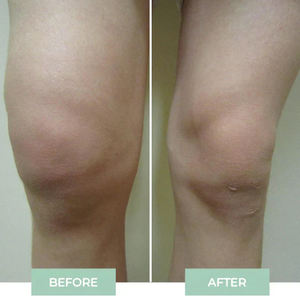 Nuevo Masajeador Corporal de Rodilla 2025, Producto Nuevo en Tendencia 2025, Dispositivo de Masaje de Fisioterapia - Product Image 4