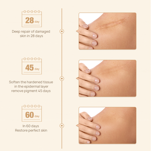 Sérum et Crème pour l'Élimination des Cicatrices d'Acné, des Boutons et des Vergetures à Base de Plantes, Convient à Tous les Types de Peau - Product Image 6