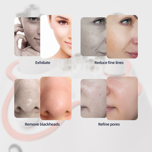 Appareil de microdermabrasion au diamant 3 en 1, jet d'oxygène, peeling, haute fréquence, nettoyage des pores du visage, blanchiment de la peau - Product Image 6