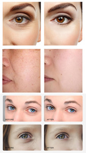 Micro-prothèses professionnelles pour le visage et les yeux, rajeunissement de la peau, régénération du collagène, appareil de beauté anti-rides - Product Image 6
