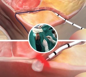 Diodo láser cirugía 980nm hemorroides pilas buasir hemorroides fístula láser ablación proctología láser - Product Image 4