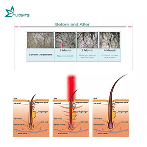 เครื่องบำบัดผมด้วยเลเซอร์650nm ประสิทธิภาพสูงช่วยให้เส้นผมงอกใหม่ได้เป็นคุณสมบัติในการซ่อมแซมเส้นผมสำหรับใช้ในคลินิกร้านเสริมสวย - Product Image 3