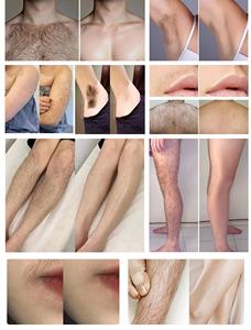 เครื่องกำจัดขนด้วยเลเซอร์ 808 นาโนเมตร ระดับมืออาชีพ สำหรับทุกสภาพผิว พลังงานคงที่ ใช้งานได้นาน - Product Image 4