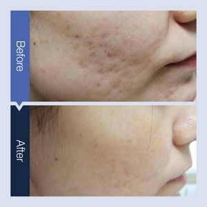 Máquina de Belleza Profesional con Láser Fraccional de CO2 Portátil para Eliminación de Arrugas y Cicatrices, Rejuvenecimiento de la Piel y Peeling de Carbón - Product Image 4