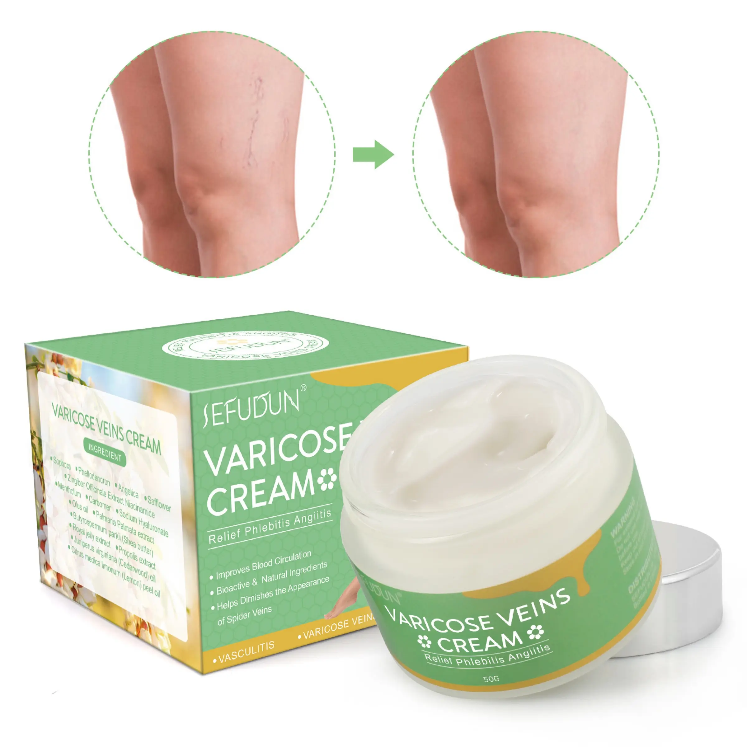 Tratamiento Natural para la eliminación de venas varicosas, crema para aliviar la flebitis, angitis, remedios caseros para venas de araña