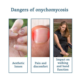 Крем для ног, удаление грибков, сыворотка, гель, противоинфекционный, пароникихия, лечение грибков - Product Image 6