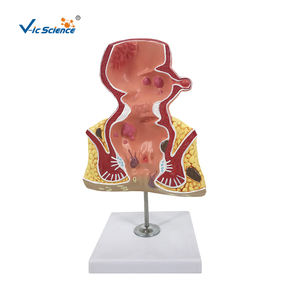 Modèle d'anatomie du rectum avec pathologies Modèle d'anatomie du rectum avec pathologies Démonstration de la maladie du rectum pour les sciences médicales - Product Image 1