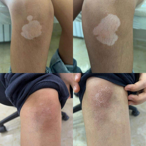 <span class=keywords><strong>Lampe</strong></span> excimère Kernel KN 5000C 308NM à usage clinique, <span class=keywords><strong>luminothérapie</strong></span> excimère 308 nm pour traiter le vitiligo et autres affections cutanées - Product Image 4