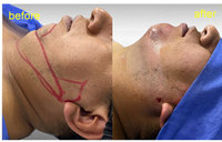 Machine de liposuccion au laser diode 980nm1470nm, machine de remodelage corporel, lifting facial endolaser 1470nm