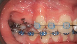 Prix usine de haute qualité Smile-ortho Advance appareil dentaire oeillet d'éruption orthodontique Tube simple/Double - Product Image 4