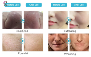 Làm sạch sâu Hydro dermabrasion làm sạch da mặt máy nhà salon da vẻ đẹp máy lột Tính năng nhắm mục tiêu cho chăm sóc da mặt - Product Image 5