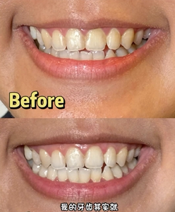Dispositivo de Blanqueamiento Dental LED Rojo y Azul, Sin Irritación de Encías, Seguro para Uso Diario Profesional en Centros de Spa - Product Image 6