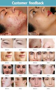 Equipo Láser de CO2 al Mejor Precio, Brazo Articulado con Diodo Rojo, Eficaz para Cicatrices, Pecas y Rejuvenecimiento - Product Image 3