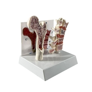 Modèle de pathologie de l'ostéoporose Modèle d'ostéoporose de vertèbre humaine Ensemble de modèles osseux ostéoporotiques - Product Image 4