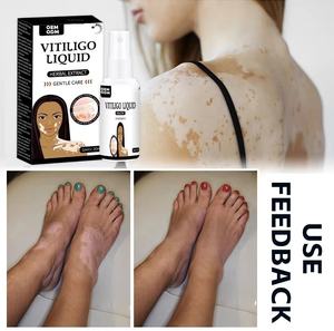 OEM üretici toptan <span class=keywords><strong>2025</strong></span> sıcak satış sağlık kaynağı düzensiz cilt rengi Vitiligo için etkili cilt beyazlatma kabartma - Product Image 6