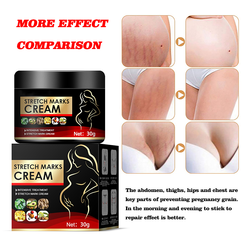 natural organic skin repair anti vergeture for pregnancy repair scar mark stretch mark remover cream