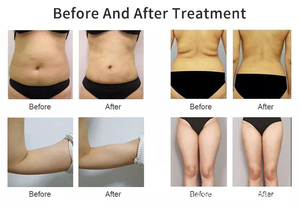 Chuyên nghiệp liposonixed chất béo hòa tan máy cho cơ thể điêu khắc Cellulite giảm và Da Thắt Chặt Loại bỏ nếp nhăn thiết bị - Product Image 3