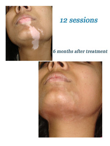 Lámpara de fototerapia de banda estrecha para vitiligo, equipo de fisioterapia Premium, aprobado por CE, superventas, NB, UVB, de banda estrecha - Product Image 6