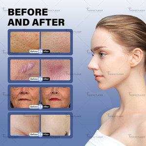 2025 mới xách tay 60 Wát 10600nm fractional CO2 laser chuyên nghiệp da đổi mới và tái tạo bề mặt CO2 fractional máy laser - Product Image 6