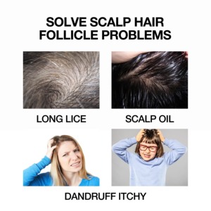 Set Profesional <span class=keywords><strong>para</strong></span> el Cuidado del Cabello Contra Piojos y <span class=keywords><strong>Liendres</strong></span>, Champú y Acondicionador Anti-Picazón - Product Image 6