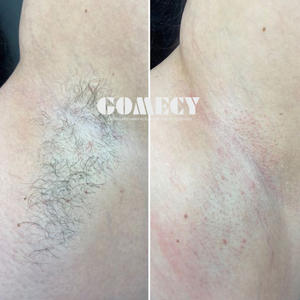 Appareil d'épilation au <span class=keywords><strong>laser</strong></span> à diode intelligent portable le plus vendu <span class=keywords><strong>2022</strong></span>, haute puissance 755 808 1064nm - Product Image 3