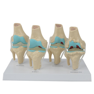Modèle de genou articulé malade à 4 étapes - Le fabricant fournit des équipements pédagogiques médicaux - Product Image 4