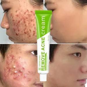 Trattamento naturale dell'acne 100% prodotti a ricezione pura crema per il viso Vegan Anti Acne