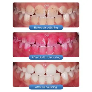 Pistola di lucidatura ad aria dentale di alta qualità compatibile 2/4 fori sbiancamento denti lucidatrice a spruzzo