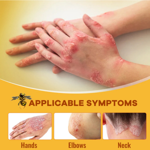 ZB <span class=keywords><strong>Eczéma</strong></span> Baume Antibactérien Crème Antiprurigineuse À Base De Plantes Érythème Prurit Dermatite Démangeaisons Psoriasis Pommade 20g - Product Image 3
