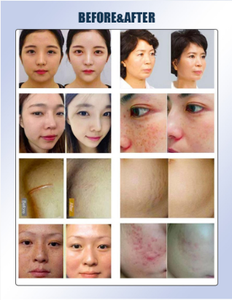 สถานีฟื้นฟูผิวอเนกประสงค์ 2-in-1 รุ่นใหม่ ผลิตจากสแตนเลสเกรดคลินิก ควบคุมความลึกได้อย่างแม่นยำ ปรับแต่งได้ - Product Image 4