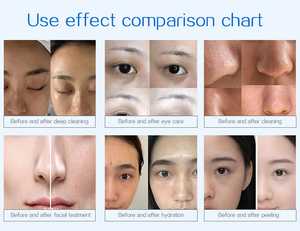 เครื่องปอกเปลือกไฮโดรมาเบรชั่น18-in-1เครื่องลอกผิวด้วยน้ำเครื่องลอกผิวหน้าด้วยหัวฉีดน้ำ - Product Image 5