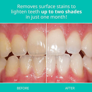 Dentifrice Blanchissant à la Menthe 35% Peroxyde de Carbamide en Seringue Usage Dentaire Professionnel Faible Sensibilité OEM Nettoyage en Profondeur - Product Image 6