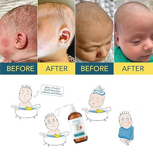 Shampooing médicamenteux de marque privée et nettoyant pour le corps-Le shampooing antipelliculaire pour bébé aide à la coiffe du berceau et à la dermatite séborrhéique réduit les rougeurs - Product Image 6