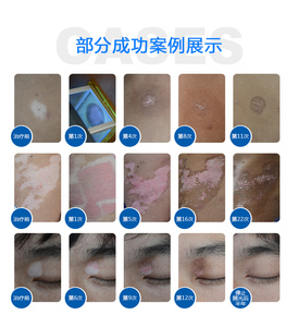 เครื่องฉายแสงยูวีบีแบบแคบ 311 นาโนเมตร สำหรับการรักษาโรคด่างขาว สะเก็ดเงิน กลาก และโรคผิวหนังอักเสบ - Product Image 6