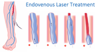 Appareil EVLT Arfurla Evltlaser pour les varices, double longueur d'onde 980 nm 1470 nm