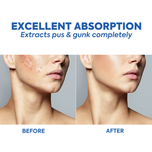 Yeni öğe akne sivilce hidrokolloid şifa yama ile çay ağacı yağı akne sivilce yama kapsayan Zits için - Product Image 2