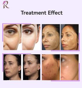 Varita Violeta de Alta Frecuencia con Accesorios de Neón y Argón para Terapia Facial, Reducción de Arrugas y Rejuvenecimiento de la Piel - Product Image 4