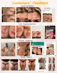 Remplissage cutané injectable personnalisé à bas <span class=keywords><strong>prix</strong></span> pour le lifting du visage anti-âge et l'élimination des rides - Product Image 5