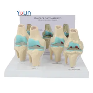 Life Size Knee Joint Disease Model 4 Stage Anatomical Model for Anatomy Teaching Anatomical Human Degenerative Knee Joint Model