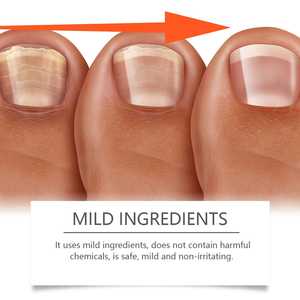 Solución Reparadora de Uñas con Veneno de Abeja de 50 ml para el Cuidado de Manos y Pies, FUNGUS DE UÑAS CON VENENO DE ABEJA - Product Image 6