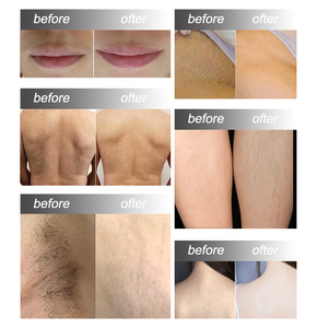 Depiladora de Diodo SH Supper Cooling para Depilación - Product Image 6