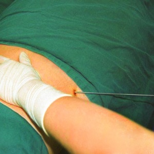    Máquina de Liposucción <span class=keywords><strong>Vaser</strong></span> de 980nm para Adelgazamiento, Máquina de Lipólisis Láser de 1470nm para Eliminación de Grasa, Máquina de Lipo Láser - Product Image 4