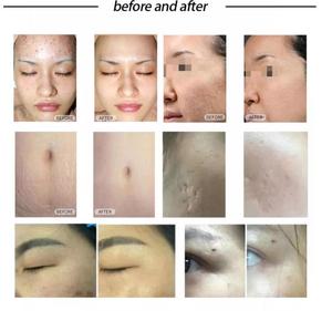 Tubo Láser de CO2 para Peeling Cutáneo, Máquina de Eliminación de Lunares con Láser Fraccional de CO2, Láser Fraccional de CO2 Coreano Pequeño de 60w para Ginecología - Product Image 6